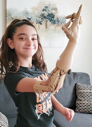  Customizable Designs: Personalizing Prosthetic Arms for Enhanced Functionality 