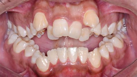  Exploring Alternative and Surgical Options for Severe Dental Crowding 