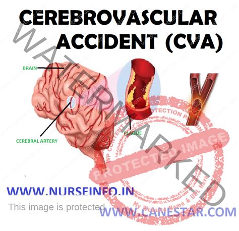 Analyzing the Emotional Factors behind Dreams of Experiencing a Cerebrovascular Accident