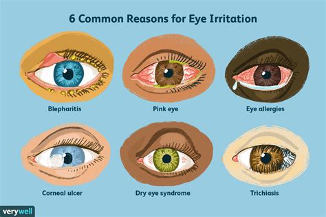 Annoying and Uncomfortable: Understanding the Sensation of Lashes in the Eye