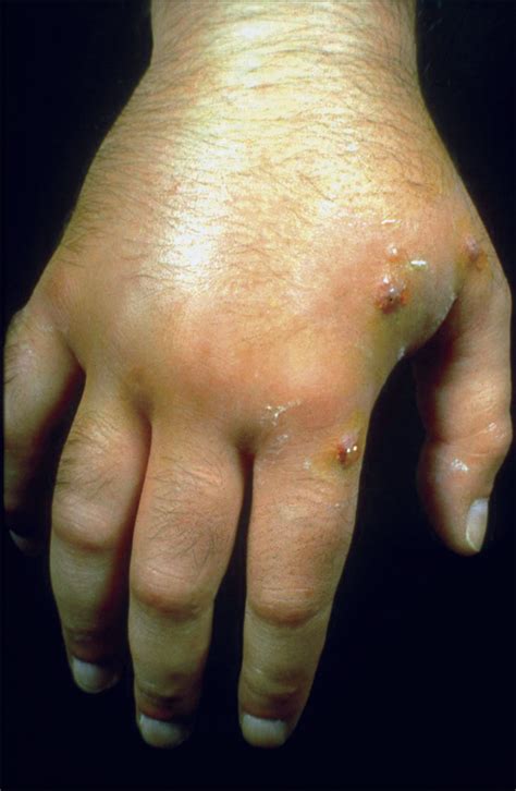 Assessing the Severity: Recognizing Signs of an Allergic Reaction Following a Centipede Bite