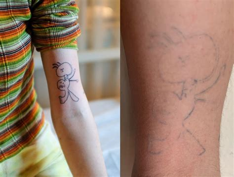 Beyond the Physical: Unveiling the Psychological Significance of Fading Tattoos