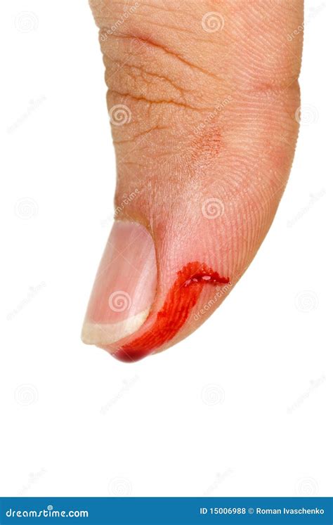 Bleeding Thumb in Dreams: A Sign of Vulnerability?