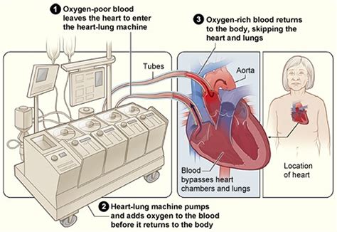 Breaking Down the Procedure: What to Expect During Cardiac Surgery