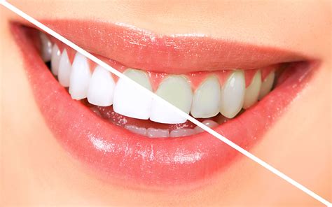 Brighten Your Smile with Teeth Whitening Techniques