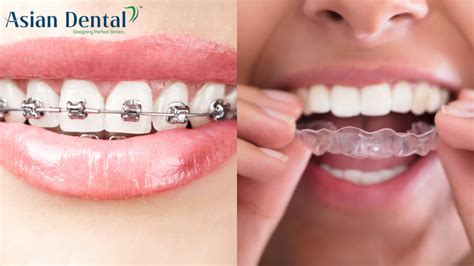 Choosing the Best Orthodontic Treatment: Braces or Aligners?