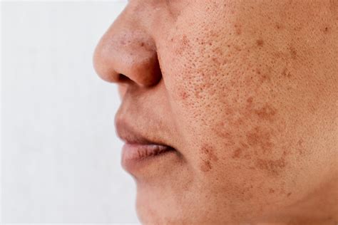 Common Causes: What Leads to Enlarged Pores?