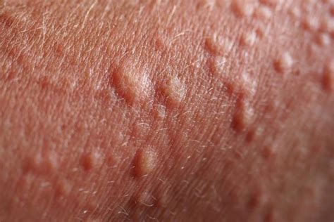 Common Conditions That Result in Skin Bumps