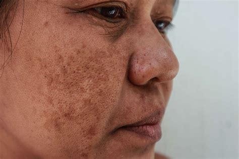 Common Medical Conditions That May Lead to Dark Patches on Facial Skin