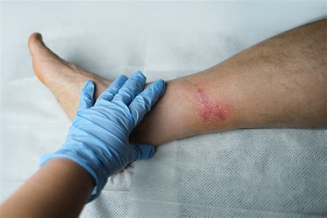 Could a Dream of a Leg Infection Be an Indication of Potentially Underlying Health Concerns?