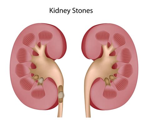 Cracking the Code: Unraveling the Symbolism of Renal Calculi