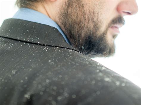 Dandruff 101: Understanding the Basics