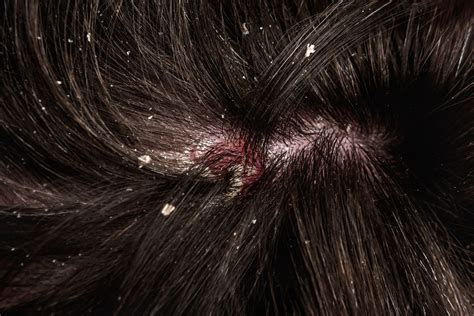 Dealing with Scalp Concerns: Effective Solutions for Dandruff and Irritation