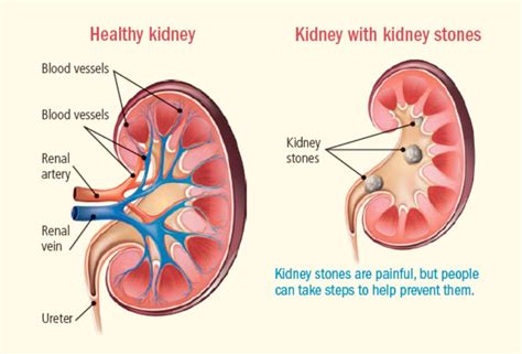 Deciphering the Meaning Behind Renal Discomfort in Sleep