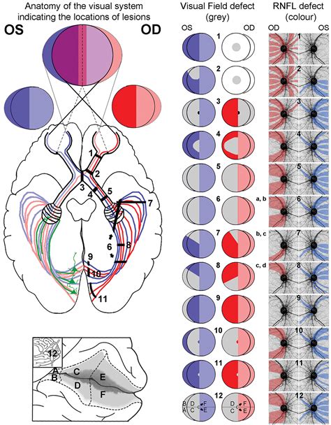 Deciphering the Neurological Foundation of Visual Anomalies