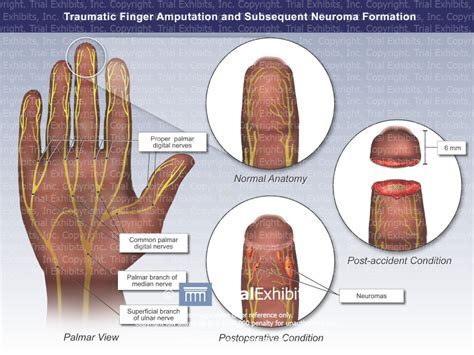 Deciphering the Significance of Finger Loss in Dreams: Practical Guidelines for Interpretation