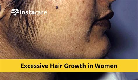 Decoding Dreams about Excessive Growth of Body Hair