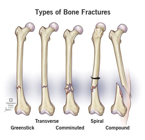 Decoding the Symbolism and Importance: Unraveling the Meanings Behind a Fractured Infant Limb