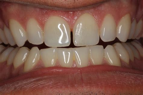 Dental Bonding and Veneers for Closing the Gap: Enhancing Your Smile