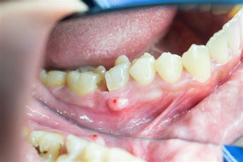 Dental Infections: Uncovering the Root Causes Behind Oral Abscesses