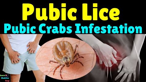 Diagnosing infestation of pubic lice: Identifying and treating the condition