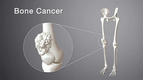 Discovering Meaning in the Midst of Bone Cancer: Exploring Personal Interpretations