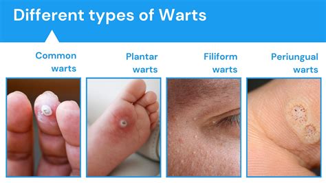 Diverse Kinds of Warts and Their Unique Attributes