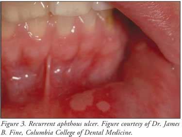 Effective Solutions for Oral Lesions in Dreams