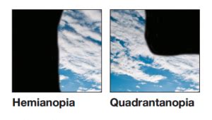 Examining the Influence of Vision Loss on Dream Content and Themes