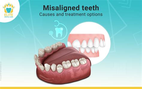 Exploring Alternative Approaches for Addressing Severe Dental Misalignment