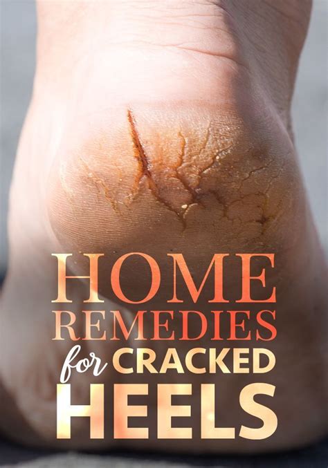 Exploring Natural Remedies for Healing Cracked Heels