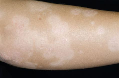 Exploring Underlying Conditions Associated with Hypopigmentation