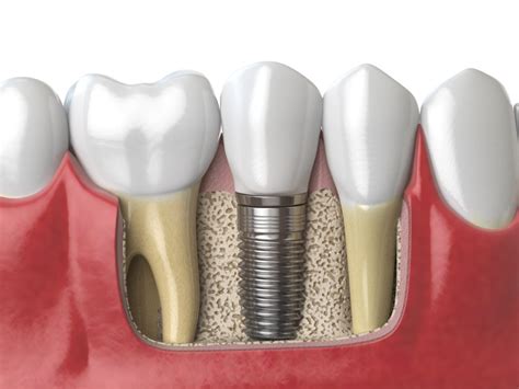 Exploring Your Options: Selecting the Ideal Implant