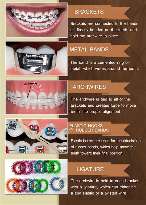 Exploring the Different Styles and Materials of Braces