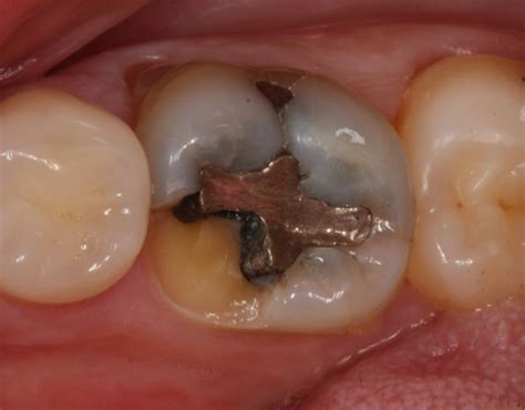 Exploring the Emotional Significance of a Fractured Tooth in a Vision