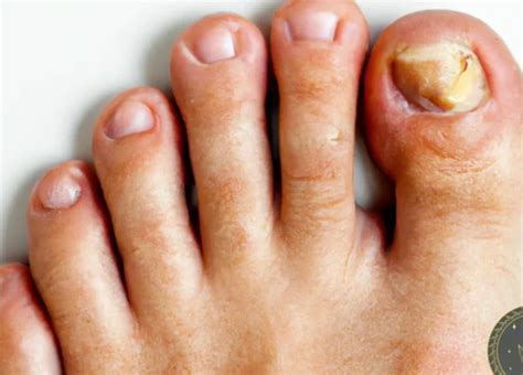 Exploring the Enigmatic Significance of a Vanished Toenail in Dreams