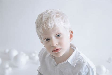 Exploring the Psychological Significance of Dreaming about an Individual with Albinism