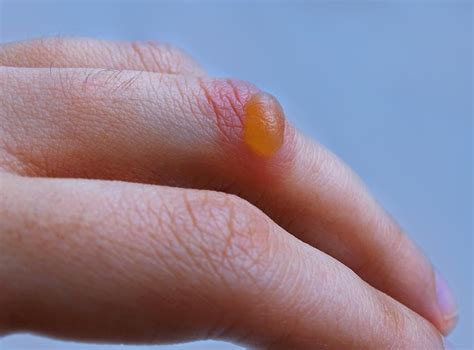 Exploring the Symbolism of Skin Blisters in Various Cultures