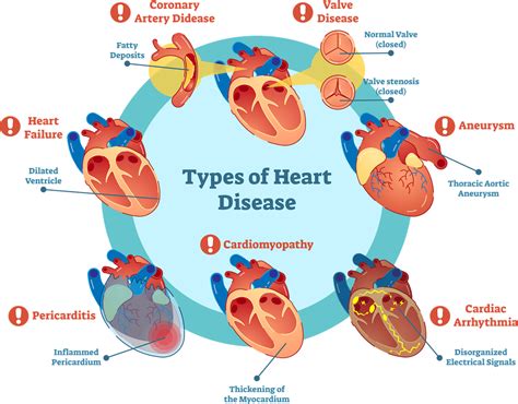 Factors behind Experiencing Dreams related to Cardiac Ailments