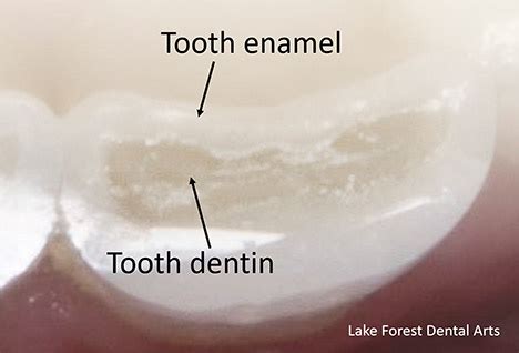 Finding Solutions: Practical tips to prevent and overcome recurring dreams about adhesive substance getting stuck in dental enamel