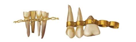 From Ancient Times to Modern Orthodontics