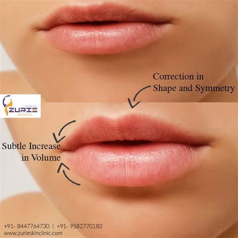 Fulfill Your Aspiration for Fuller Lips: Explore the Realm of Lip Augmentation Procedures