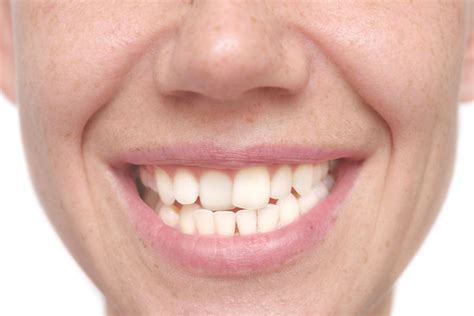 How Dreaming about Misaligned Teeth Reflects One's Self-perception