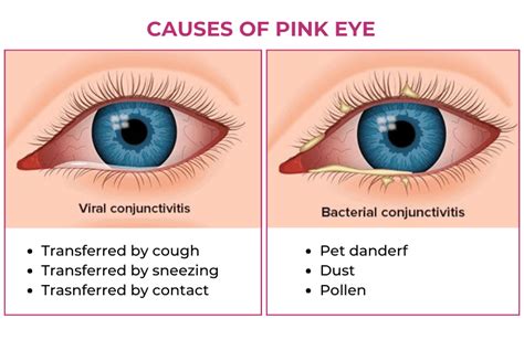 How Pink Eye Spreads: Contagiousness and Prevention