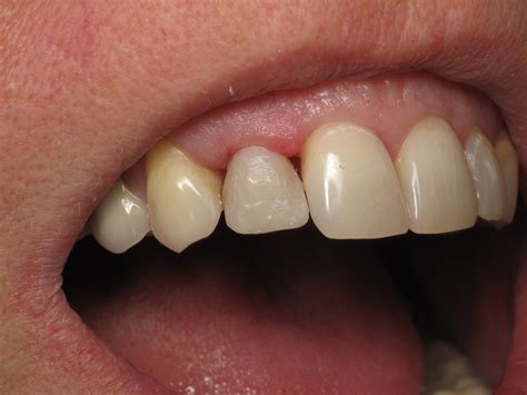 How to Address a Space in Your Front Teeth