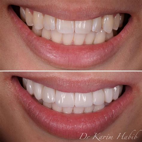 Impact of Aging and Natural Transformations on Tooth Alignment