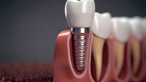 Innovations in Dental Implants: A Revolutionary Solution for Missing Teeth