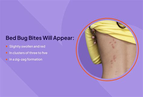 Invisible Bites: Identifying Symptoms of Bed Bug Bites