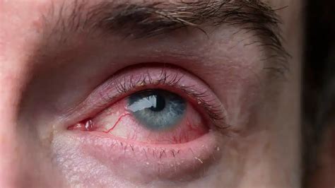 Is Pink Eye Dangerous? When to Seek Medical Help