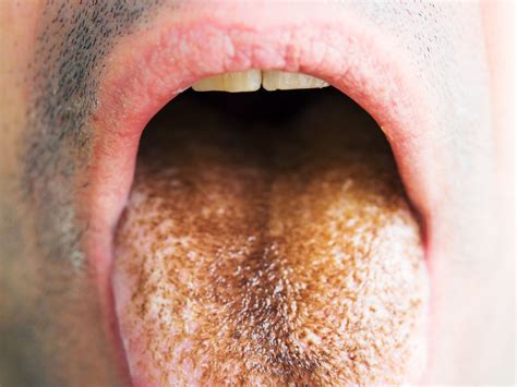 Is a Hairy Tongue a Distrustful Indicator?